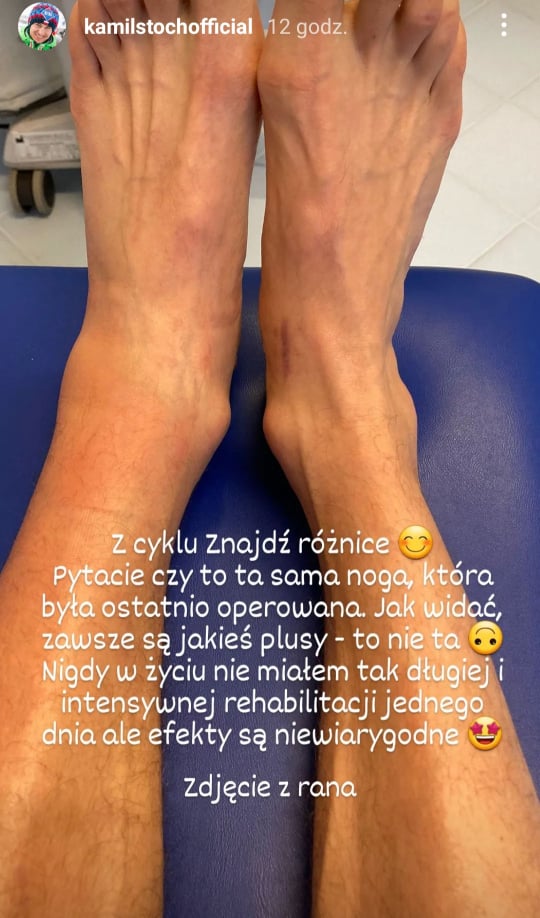 Tak wygląda kostka Kamila Stocha